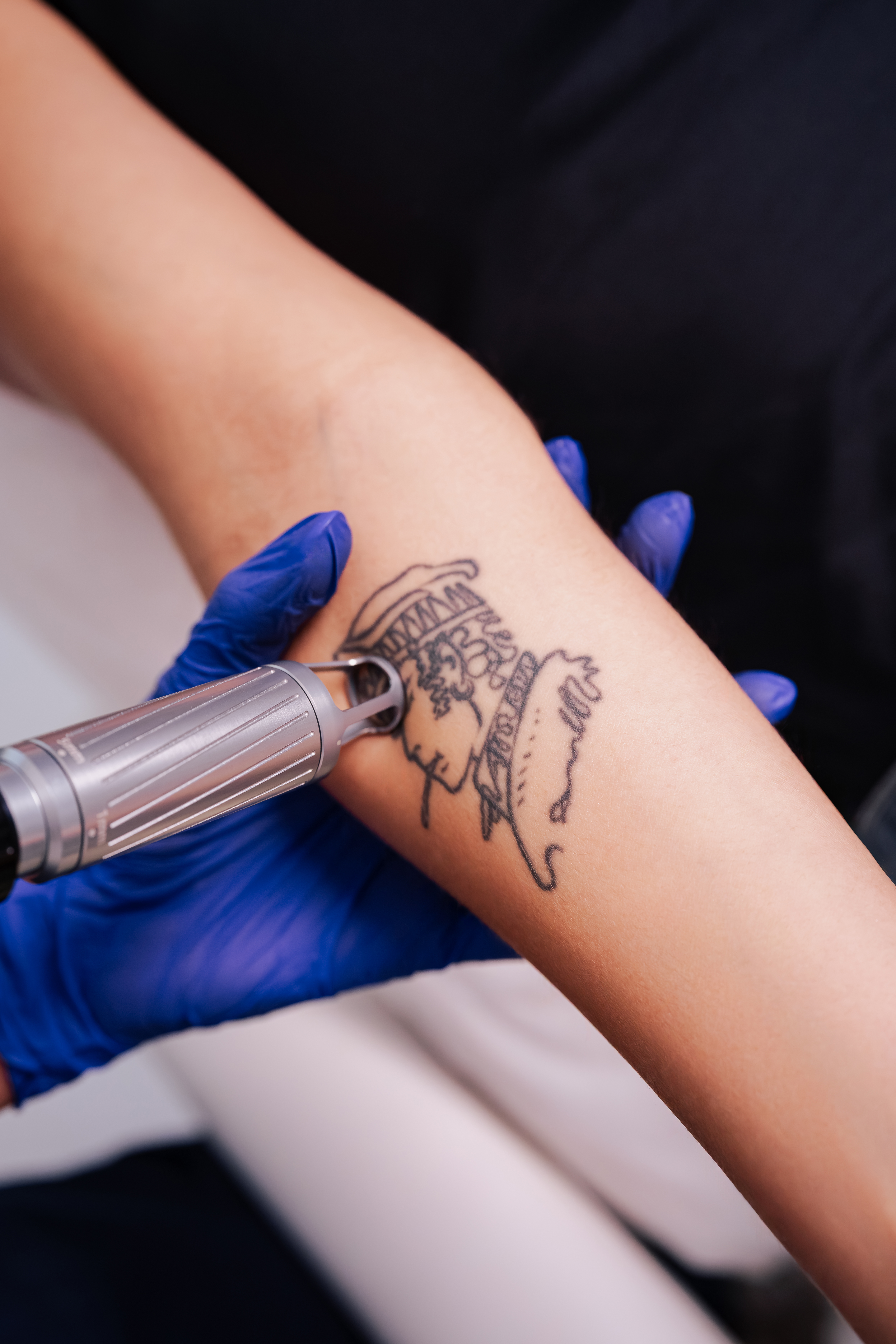 Laser Tattoo Removal
