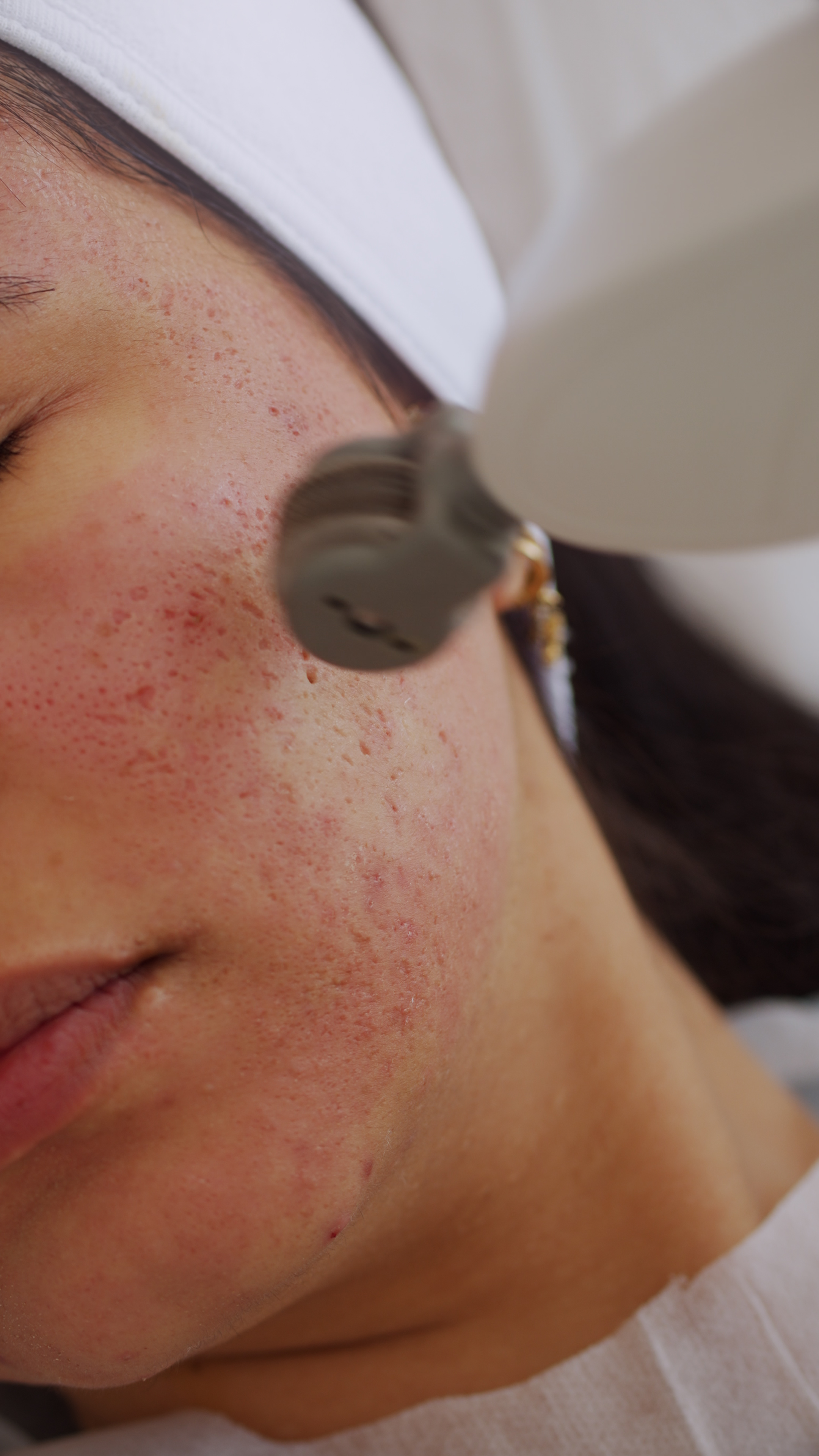 Accent Prime Skin Resurfacing