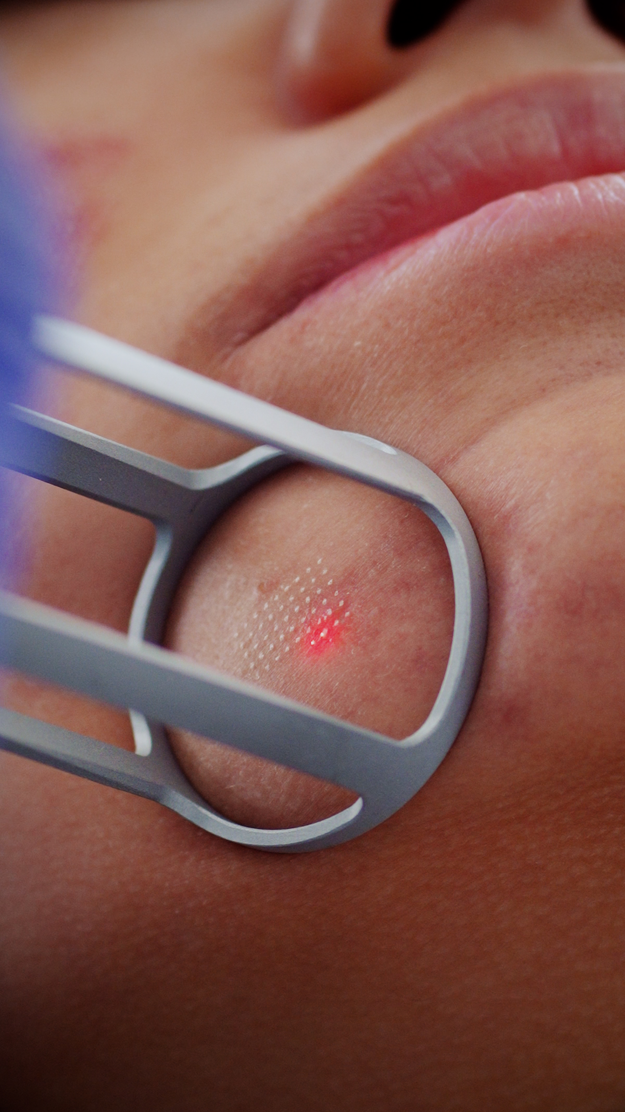 Pixel CO2 Fractional Laser